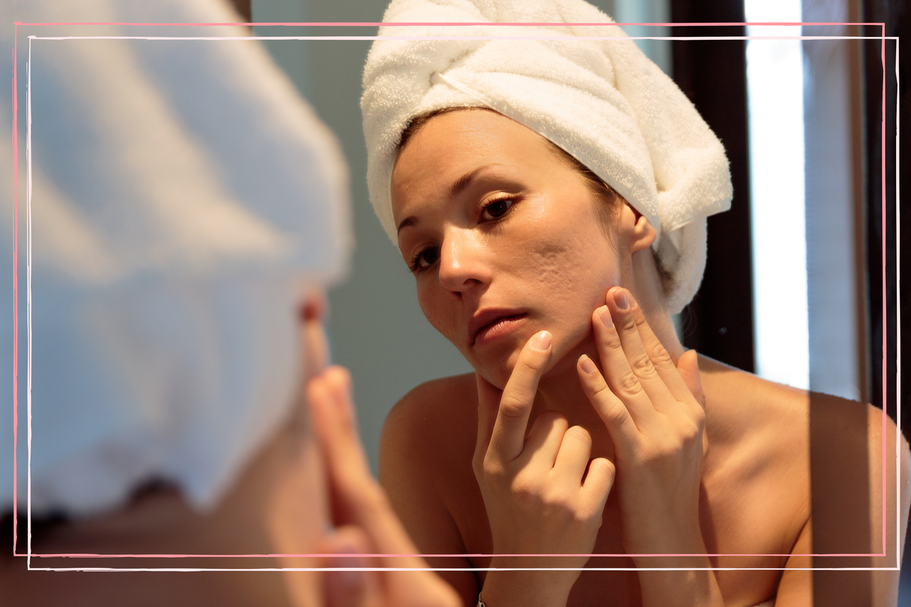 a woman inspecting her acne scars in a mirror in her bathroom