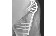 1-Radiograph-of-the-ulna-with-plates-and-screws-in-place-following-surgery-by-Rossdales.jpg