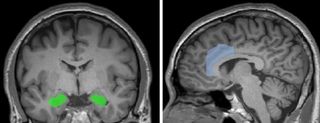 Location of amygdala (left) and dorsal anterior cingulate cortex (right).