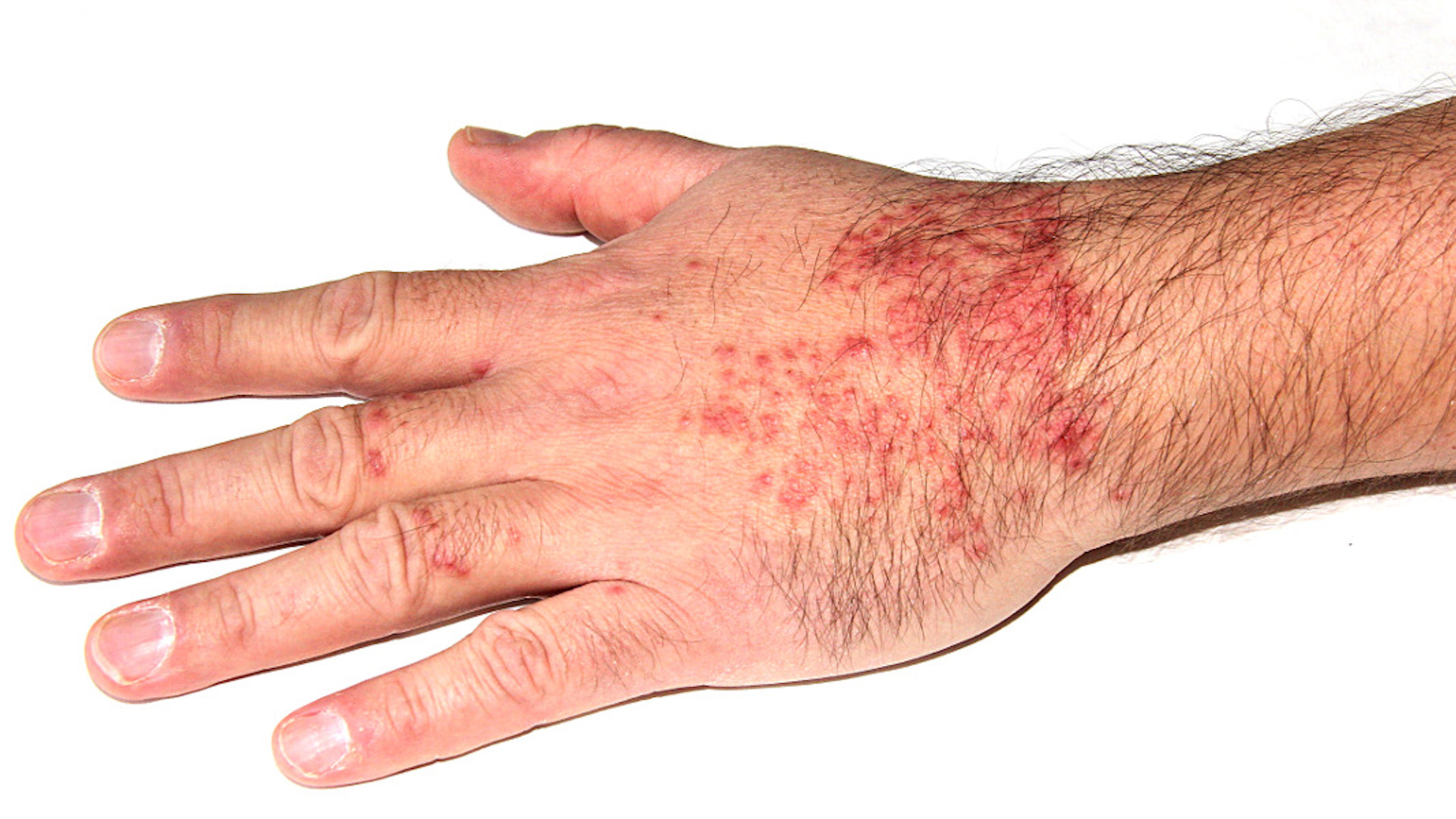 A photograph of a white man's hand with a dark red rash
