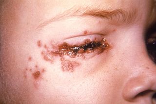 A periocular herpes outbreak occurred around the eye of a 7-year-old child with a history of recurrent herpes labialis.