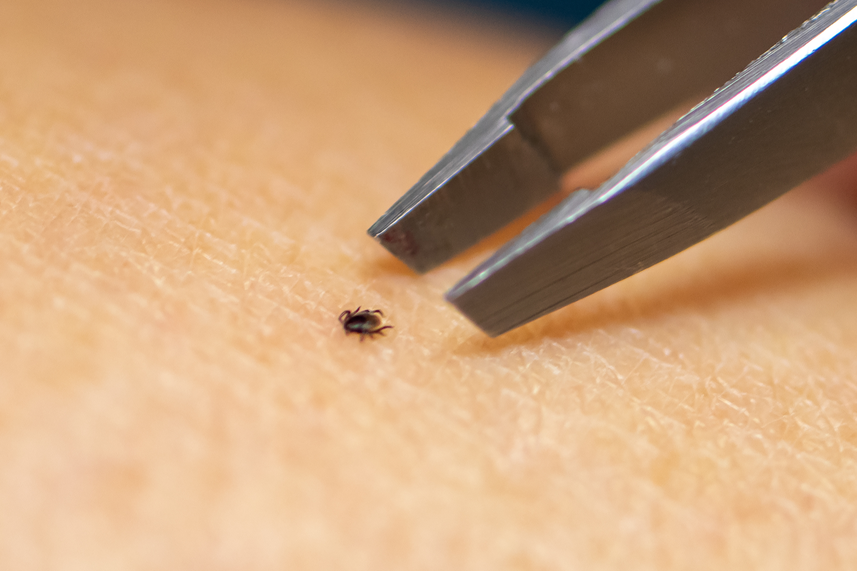 A person uses a pair of tweezers to remove a tick from their skin