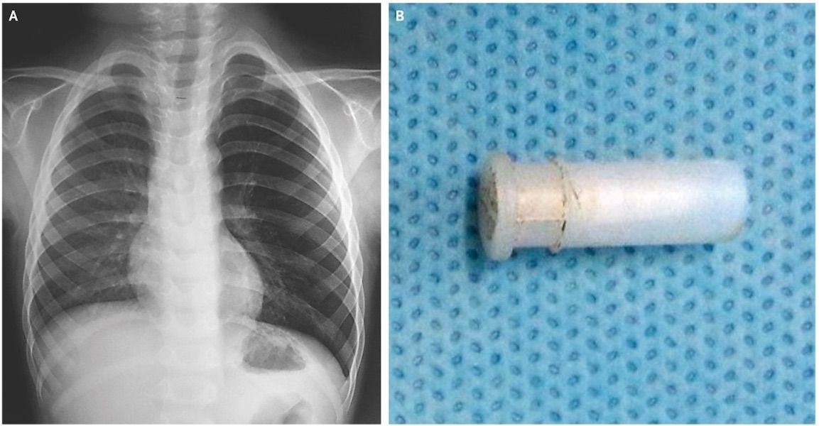 Why This Little Boy's Cough Sounds Like a Squeaky Toy Live Science