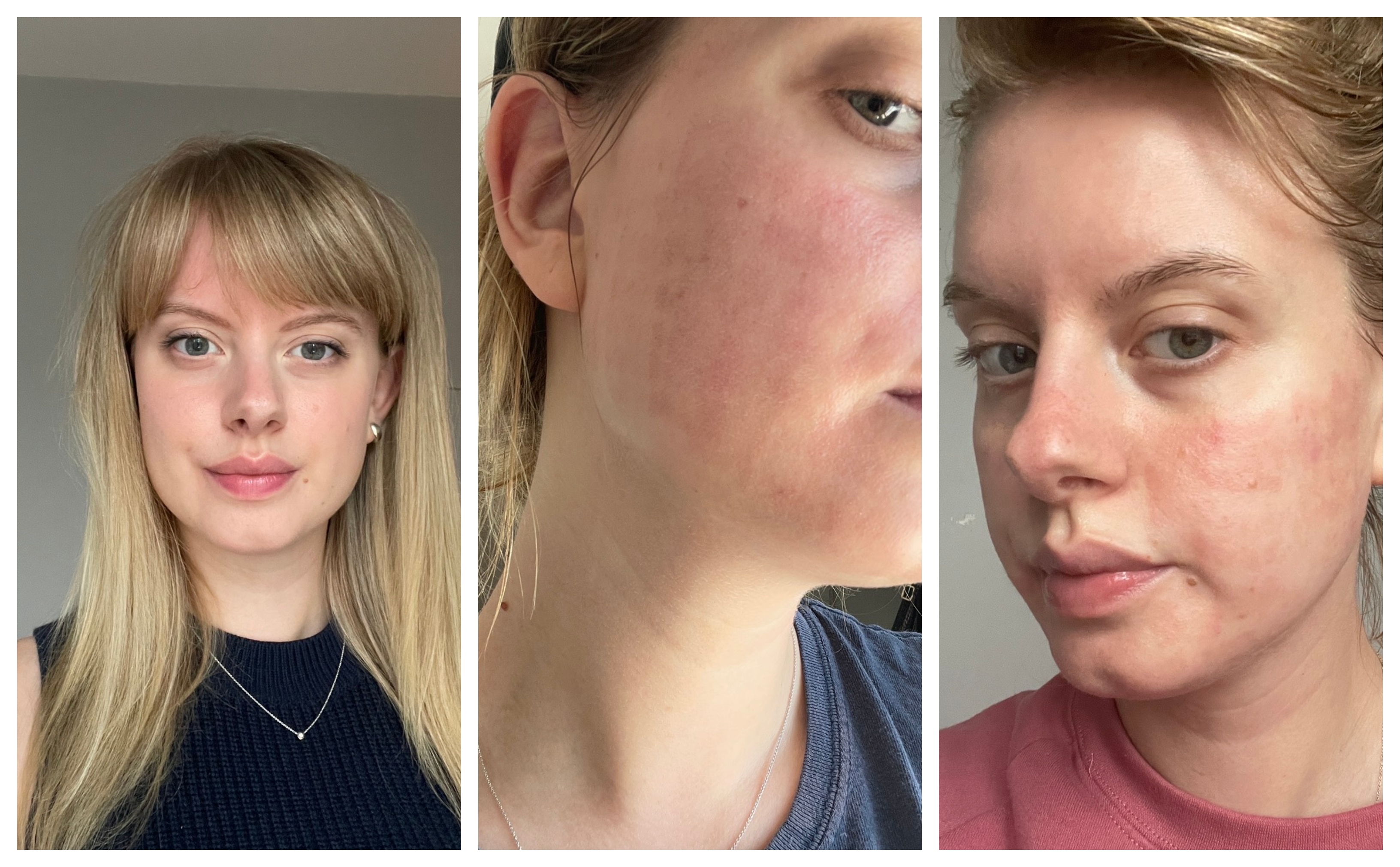 a photo triptych of a white woman with blonde hair and her skin before laser, with red marks after laser close up, and red marks after laser full face