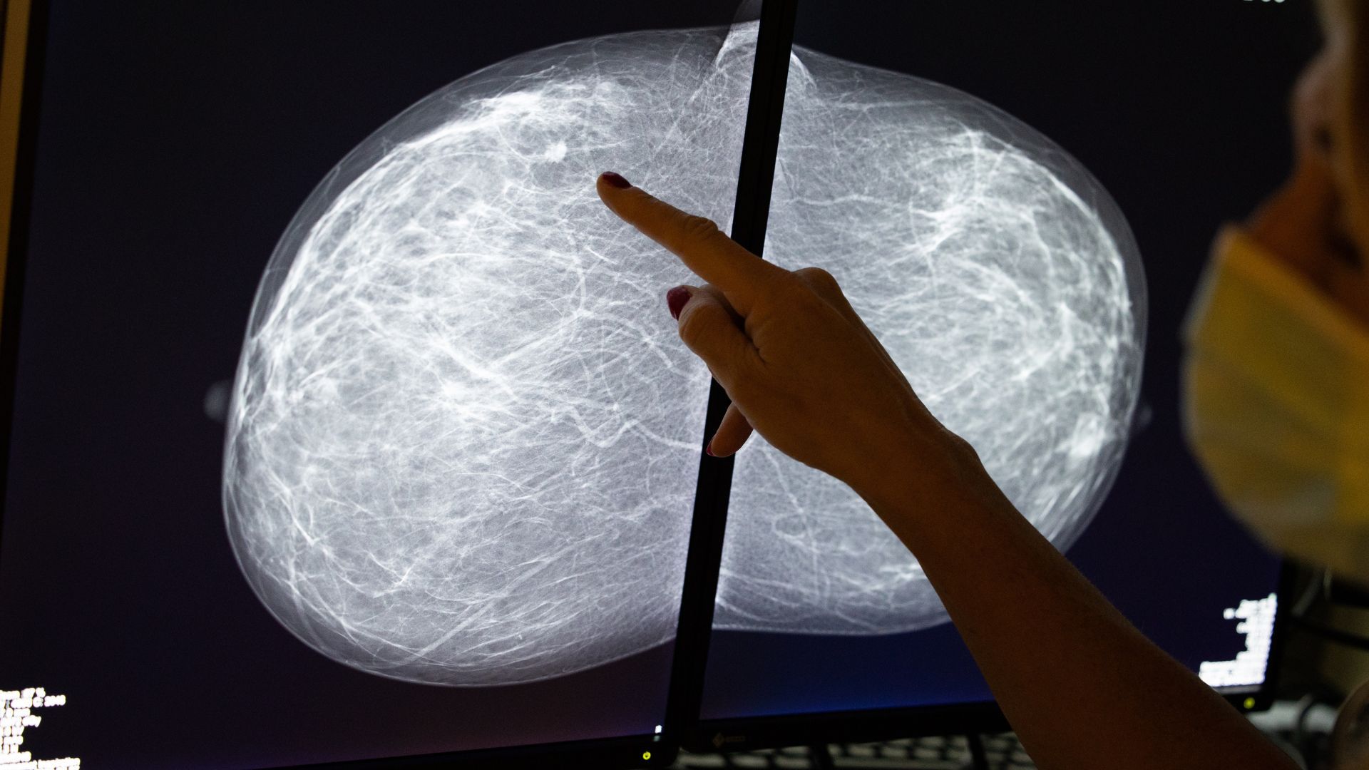 Black patients may need breast cancer screenings earlier than what many ...