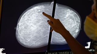 a medical provider's hand can be seen in silouette pointing to a mammogram displayed on a light board