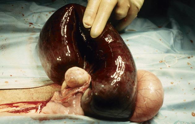 Pedunculated Lipoma