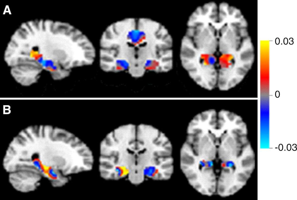 Mild Cognitive Decline Brain Scans