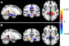 Mild Cognitive Decline Brain Scans
