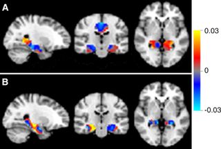 Mild Cognitive Decline Brain Scans