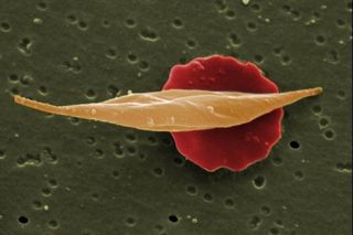 A normal blood cell behind a human blood cell of a sickle cell anaemia patient.