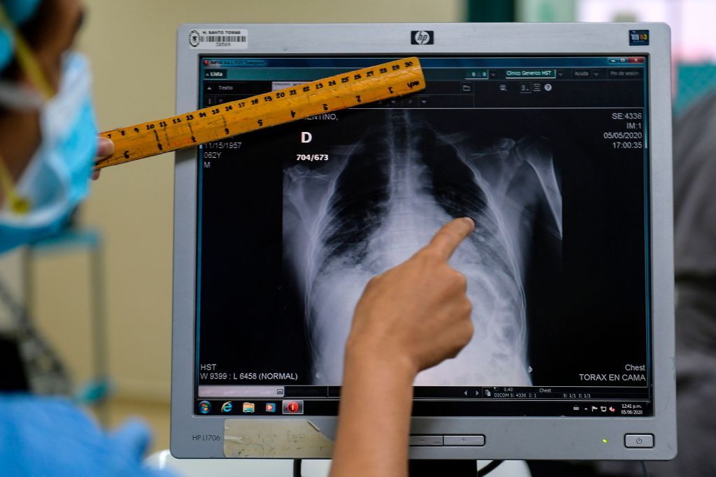 Coronavirus chest X-raay.