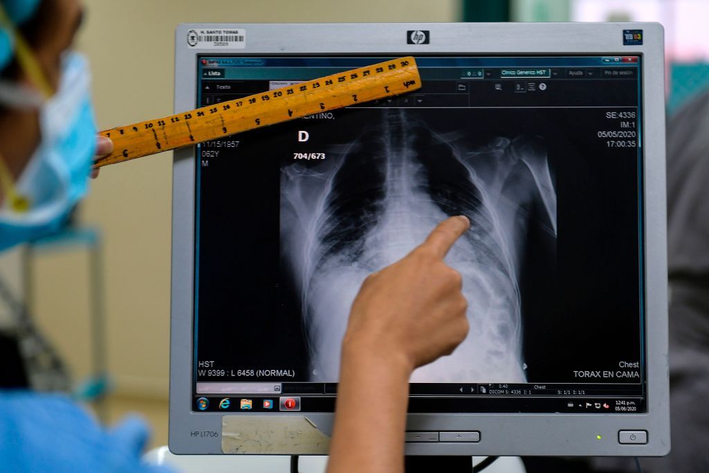 Chest Xrays could provide 'rapid, costeffective' COVID19 diagnosis when 'adequate testing is