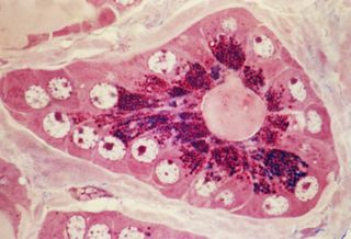 Histological view in red dye of adenocarcinoma (a cancer that starts in the mucous cells of an organ) of the exocrine pancreas.