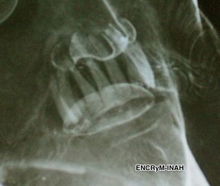 jesus statue x-ray of teeth