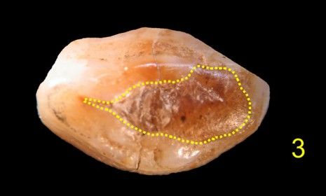 Within the dotted yellow lines a beeswax filling can be seen in the cavity of the ancient tooth.