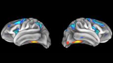 Two 3D gray brain scans have various colored sections on them against a black background