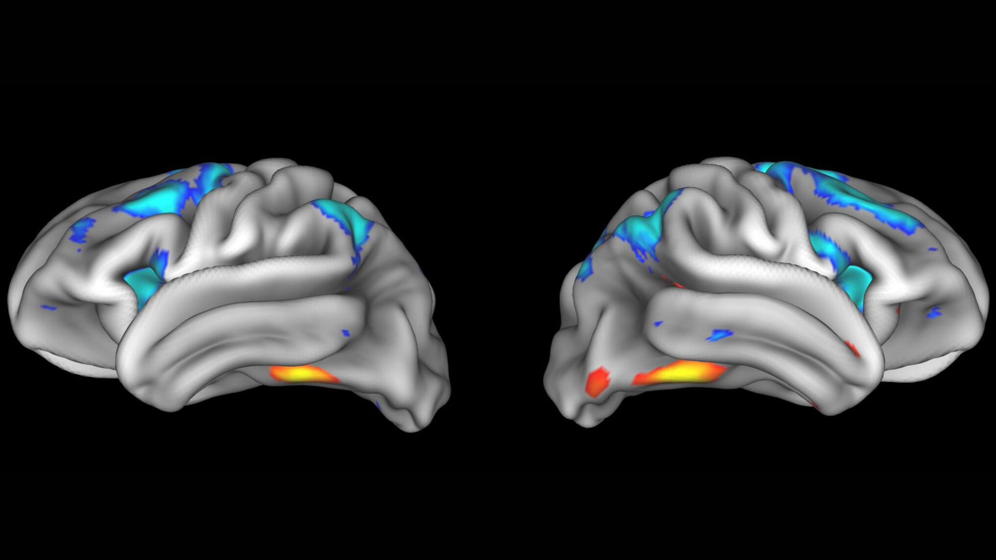 Two 3D gray brain scans have various colored sections on them against a black background