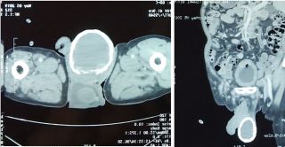 A CT scan showed that the man had calcification in his right scrotum.
