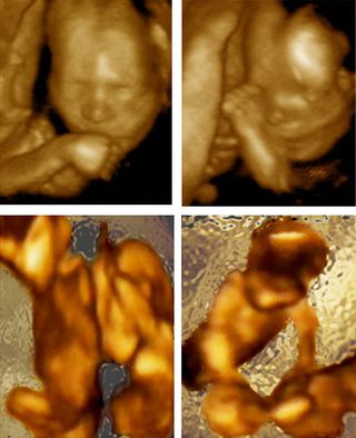 ultrasound images of twin fetuses making self-directed and other-directed movements