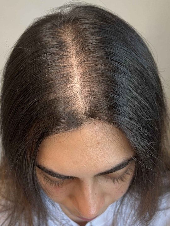 Harklinikken Hair Gain Extract Before and After 