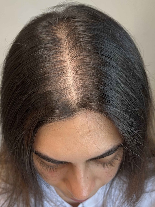 Harklinikken Hair Gain Extract Vorher und Nachher 