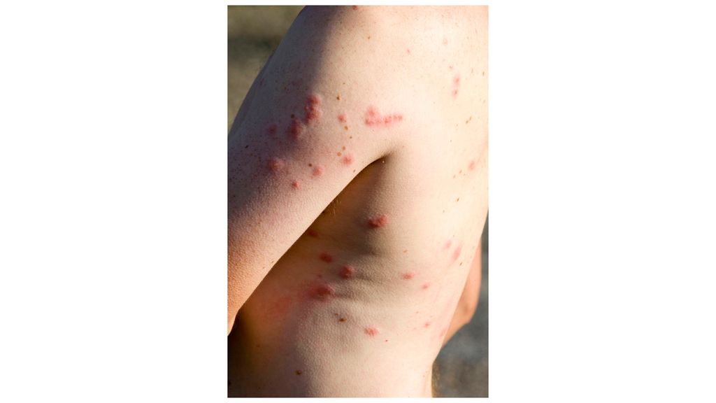 How to stop midge bites 15 expert tips Advnture