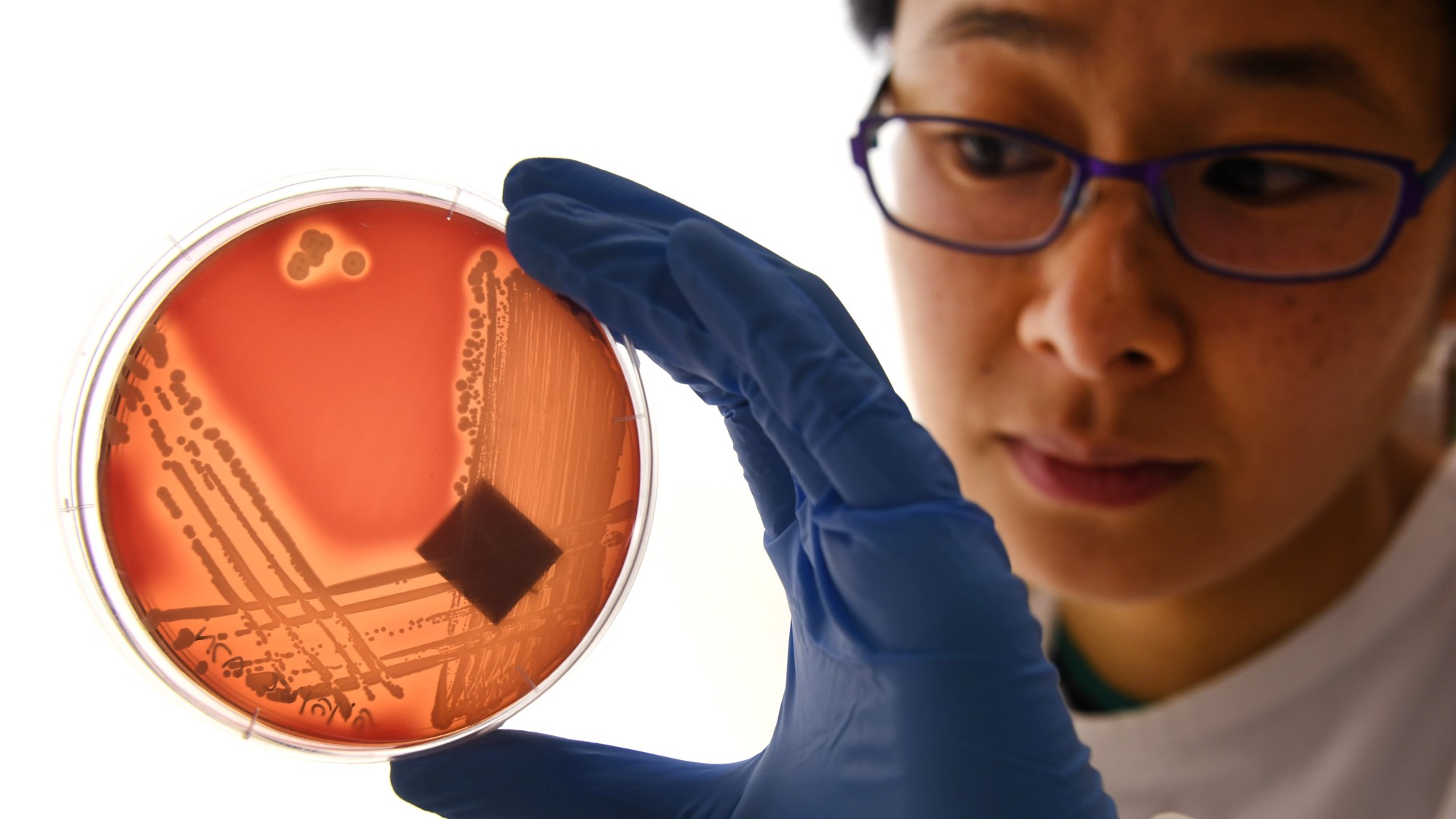 Jean Lee, a PhD student at Melbourne's Doherty Institute, inspects the superbug Staphylcocus epidermidis on an agar plate in Melbourne