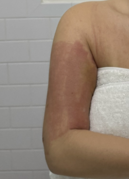 Samantha Holender's arms four days post-op. The redness is from the Genuis RF laser.