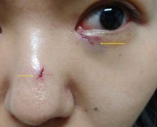 After the woman was attacked by her sister, doctors observed two small wounds under her eye and on her nose.