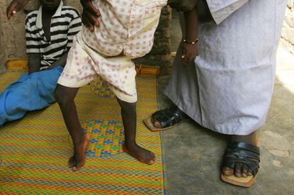 Nigerian Child with Polio