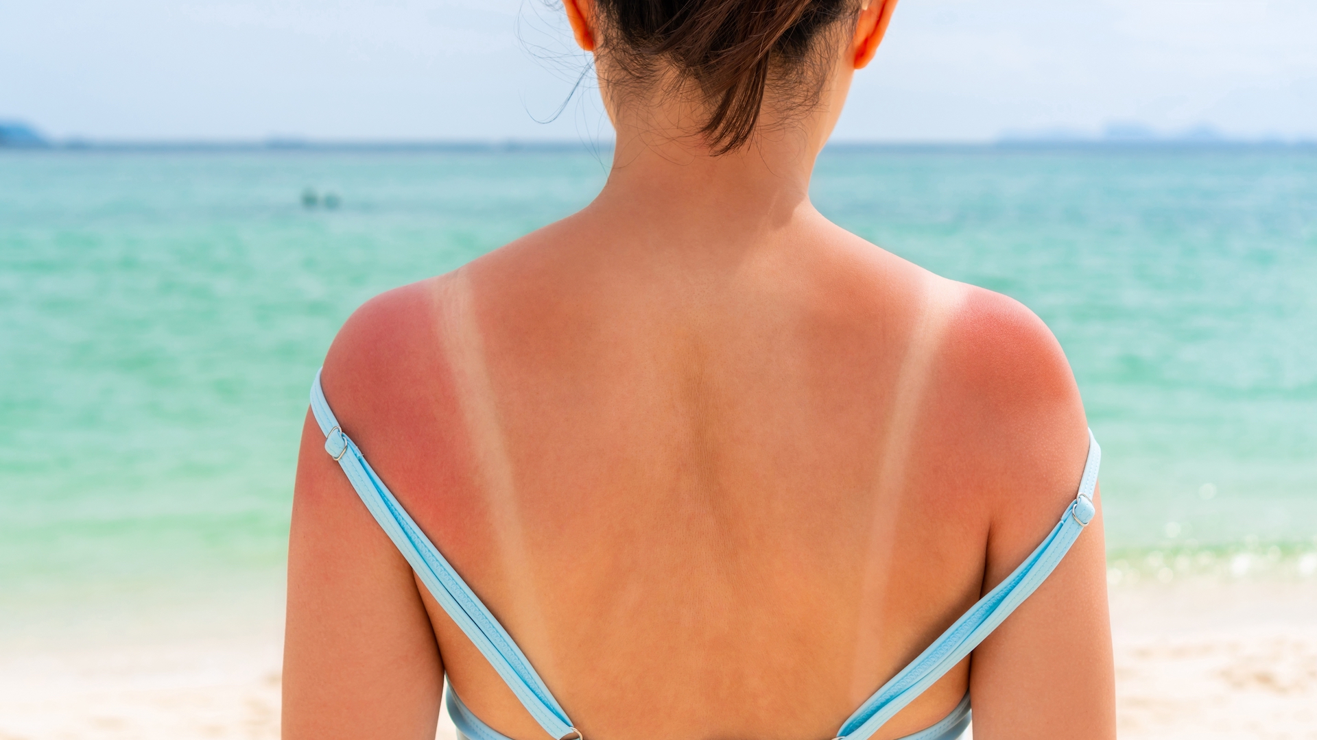 A photograph of a woman with a bad sunburn and tan lines on her back