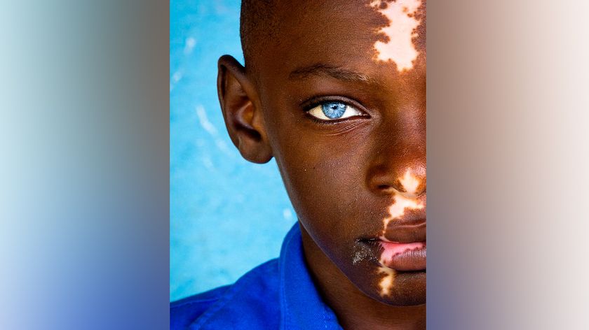 A close-up portrait of a child with dark skin, striking bright blue eyes, and patches of light skin caused by vitiligo, wearing a blue shirt against a blue background.