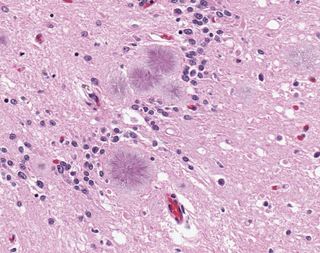 Brain tissue stained to show the features of vCJD.