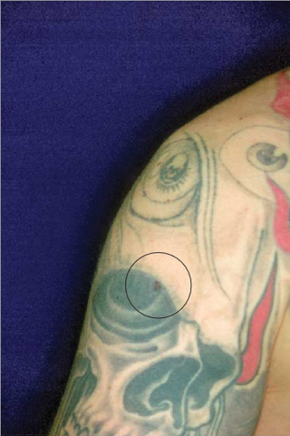 The mole is circled in a photograph taken before laser treatment.