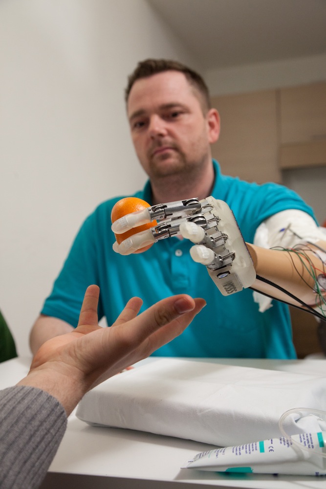 Man Gets First Prosthetic Hand That Can Feel