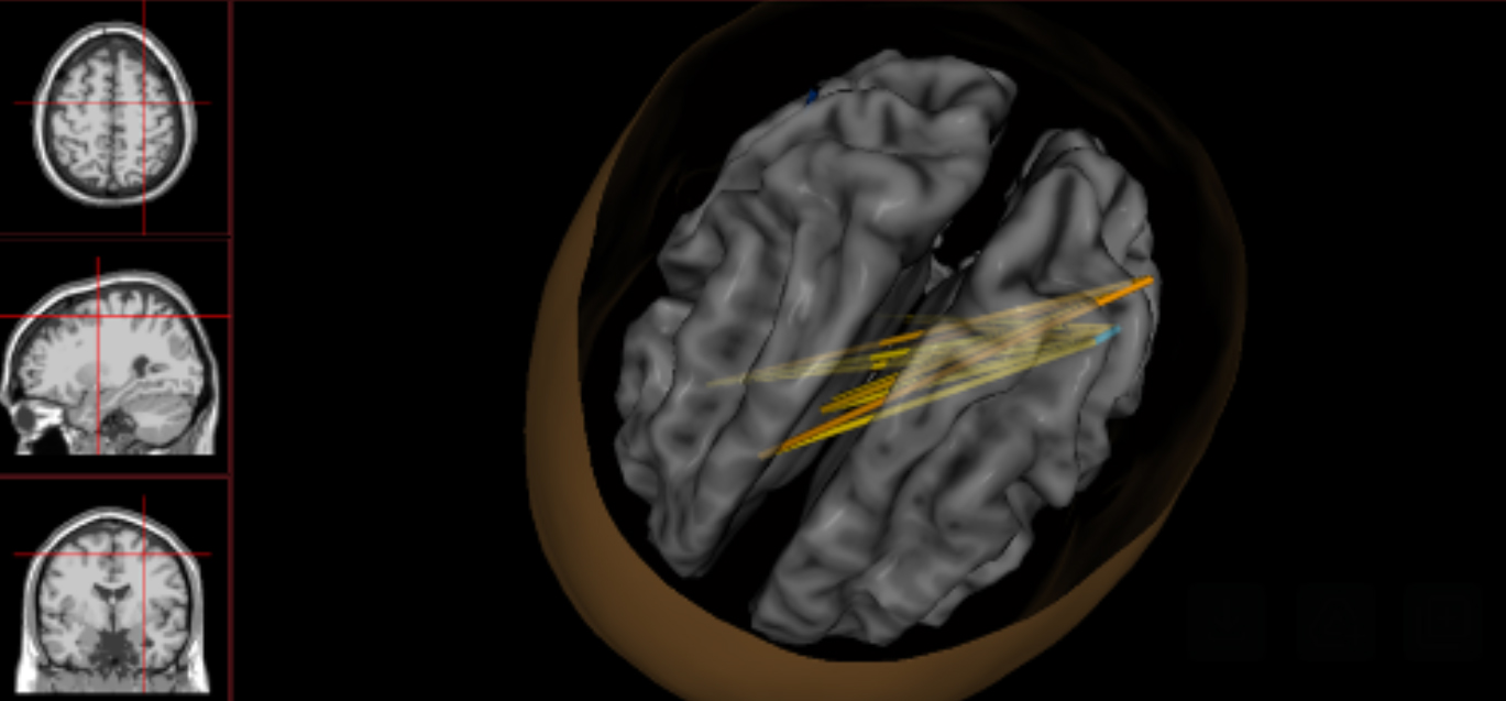A scan showing the same patient’s brain while listening to the last minute of “Soul to Soul.” The orange areas are gone. “It's astonishing,” Minton says. “We would never get such robust changes doing neurofeedback alone.”