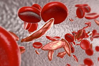 This 3D illustration of sickle cell anemia shows a blood vessel with normal red blood cells and deformed, sickle-shaped red blood cells.