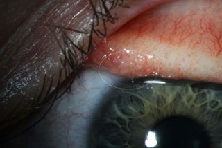 A woman in Oregon was infected with a type of eye worm never before seen in people. Above, an image of the woman's eye, with the parasitic worm (<em>Thelazia gulosa</em>) circled.