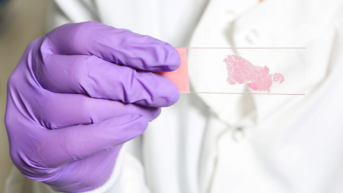 AI trained to 'think' like human pathologists may be better at spotting cancer