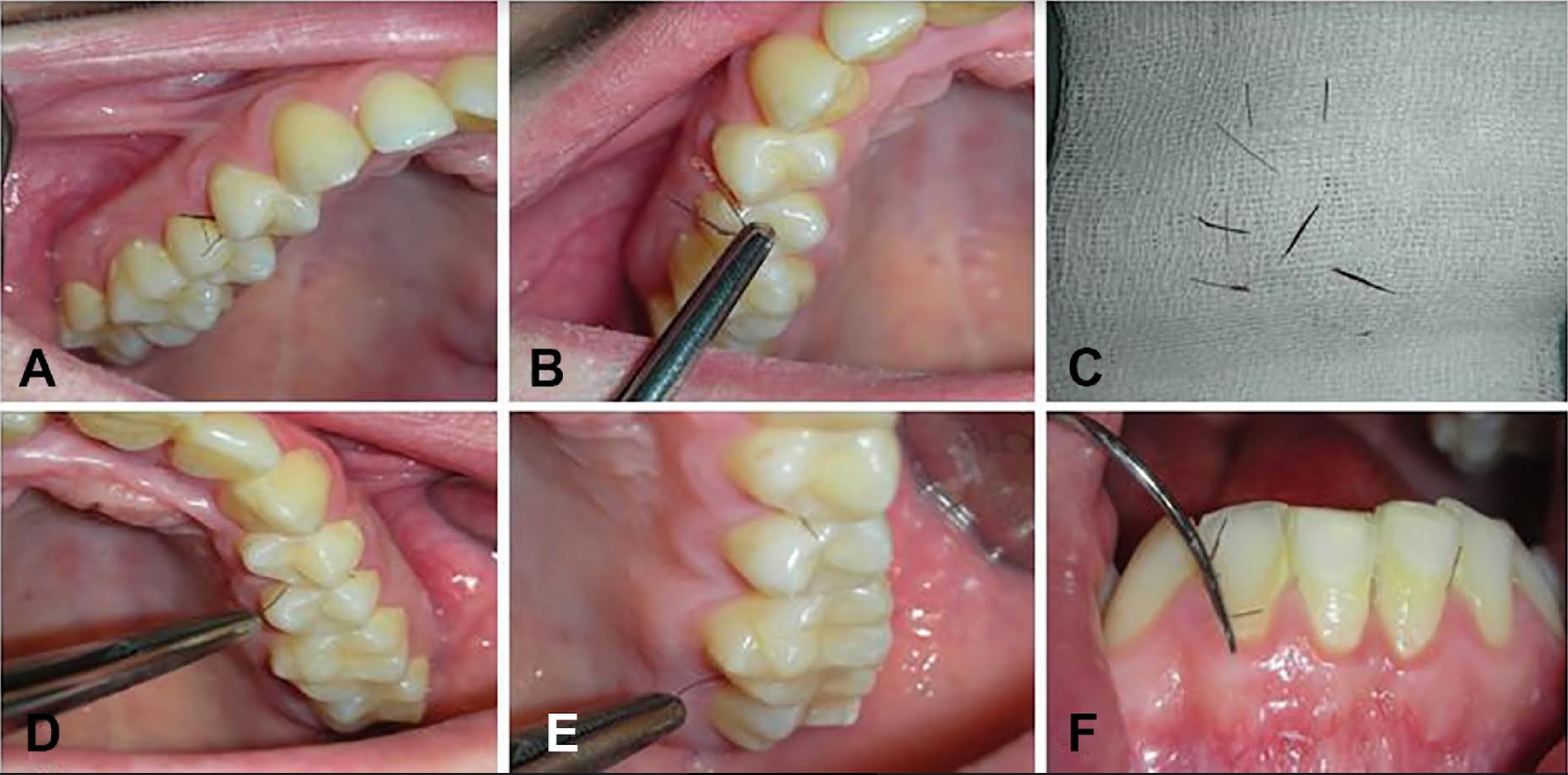 Doctors found multiple hairs growing from the woman's gums. The hairs grew back even after they were removed.