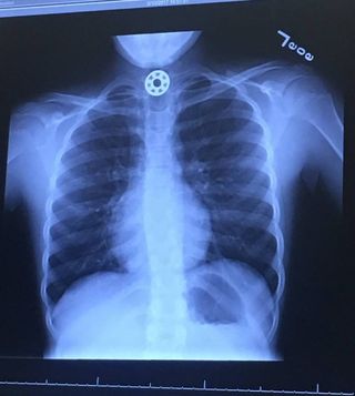 On May 13, 2017, in Texas, Kelly Rose Joniec's 10-year-old daughter accidentally swallowed part of her fidget spinner.