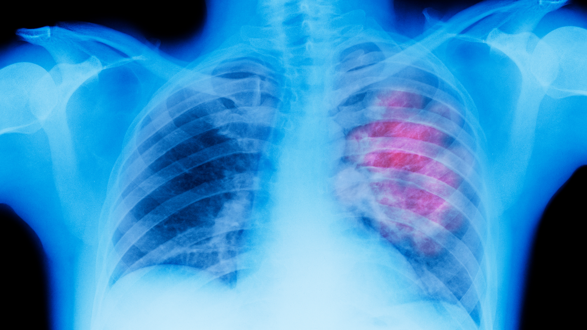 A.I. Took a Test to Detect Lung Cancer. It Got an A. - The New