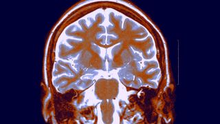 Brain MRI scan, Frontal Cut Away View