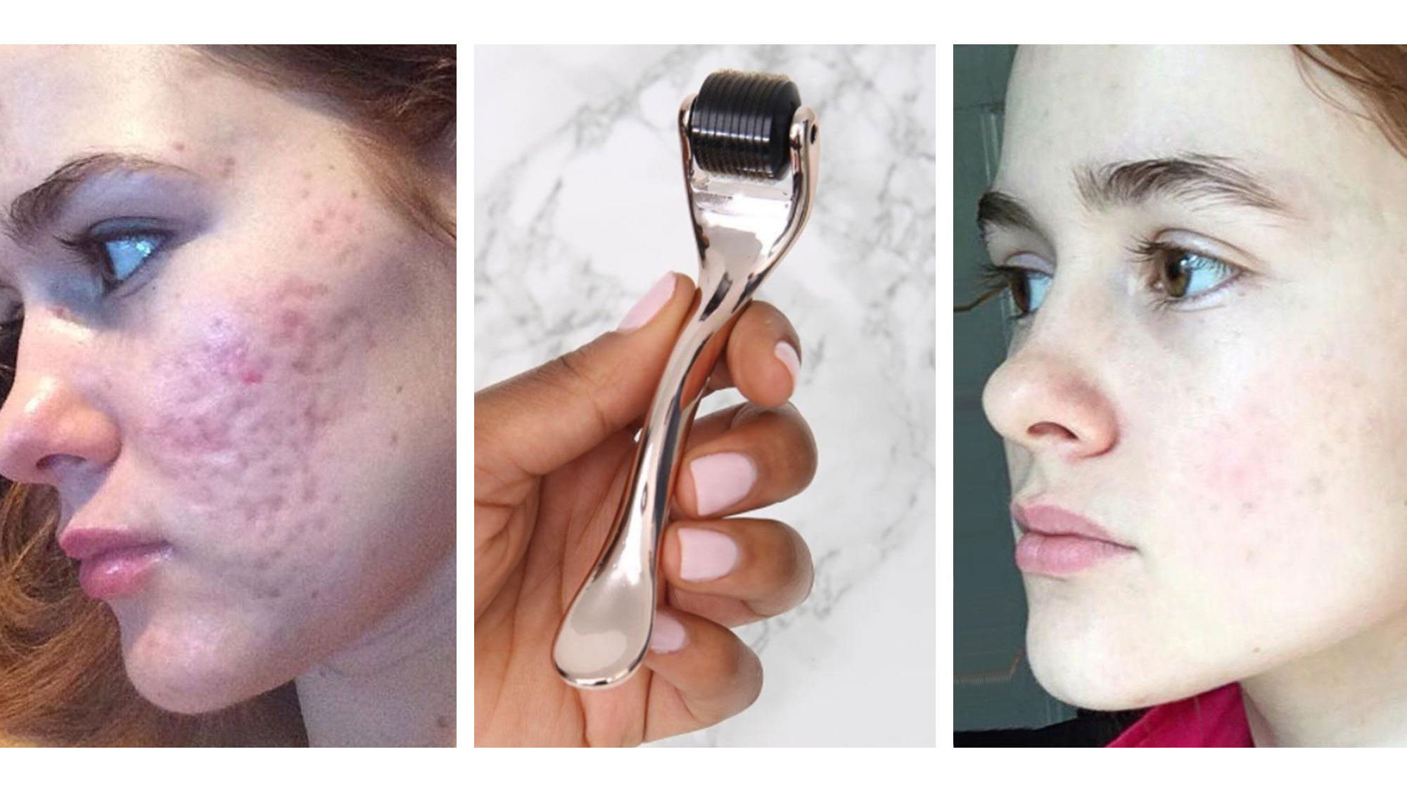 Dermarolling Before and After Pics - Dermarolling for Scars and Acne |  Marie Claire