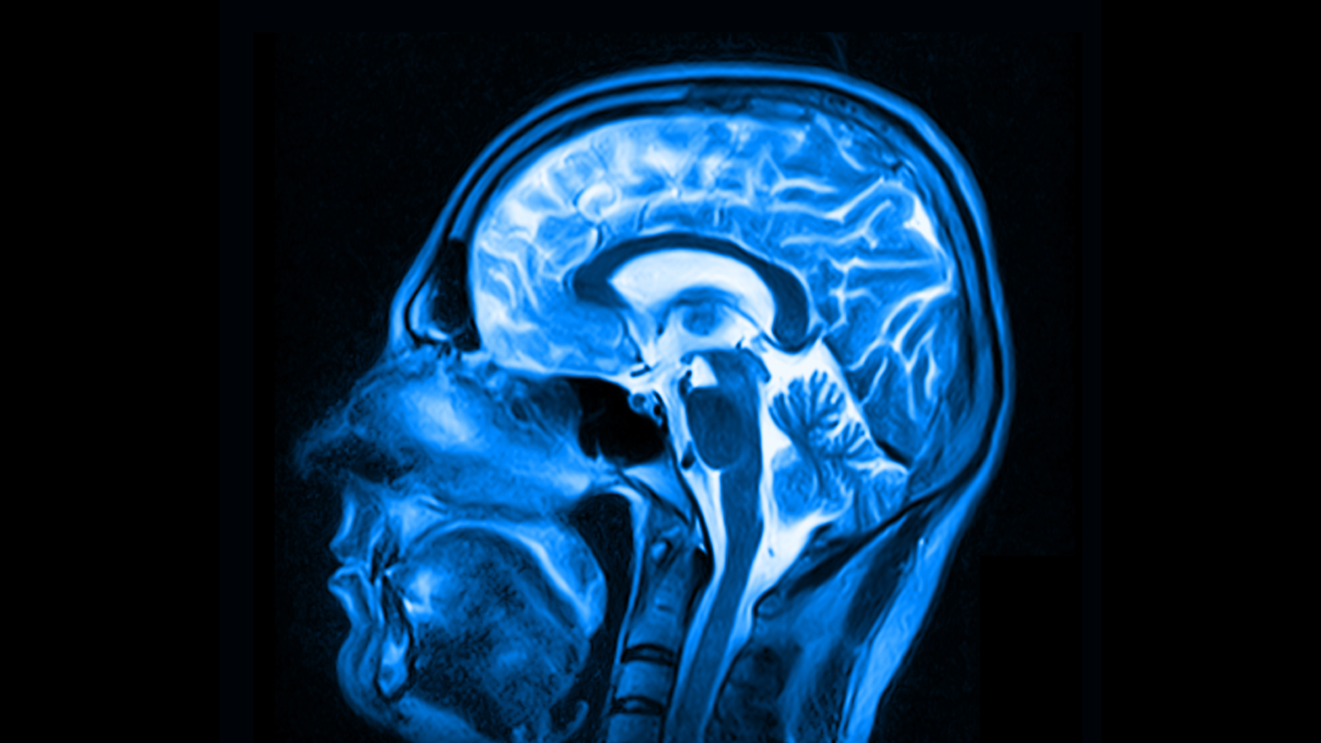 an MRI scan of a brain