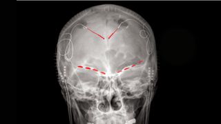 Frontal x-ray image of a human skull shows red lines where several electrodes have been implanted into the person's brain