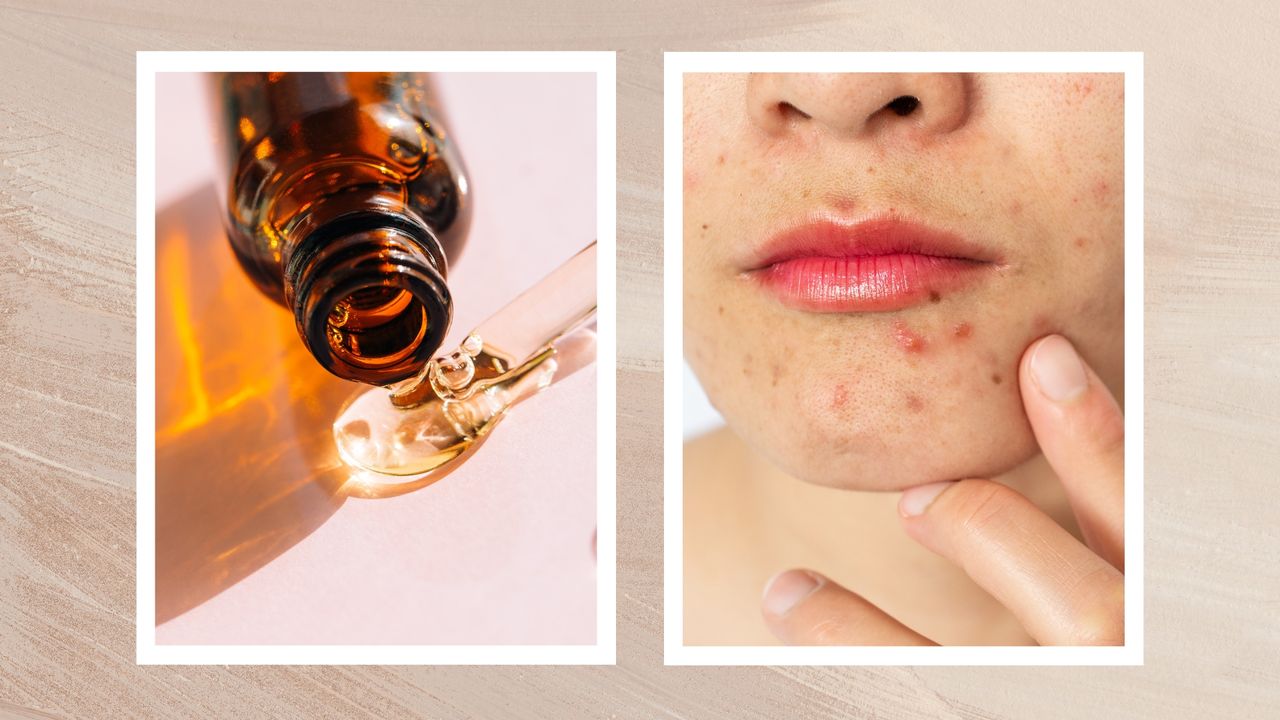 On the left, a close up of a brown glass serum bottle lying on it&#039;s side with a clear liquid spilling out, alongside a close up of a woman&#039;s chin with some visible spots to represent vitamin C for acne/ in a beige textured template