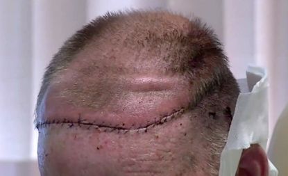 A Texas man got a scalp-skull transplant, a medical first