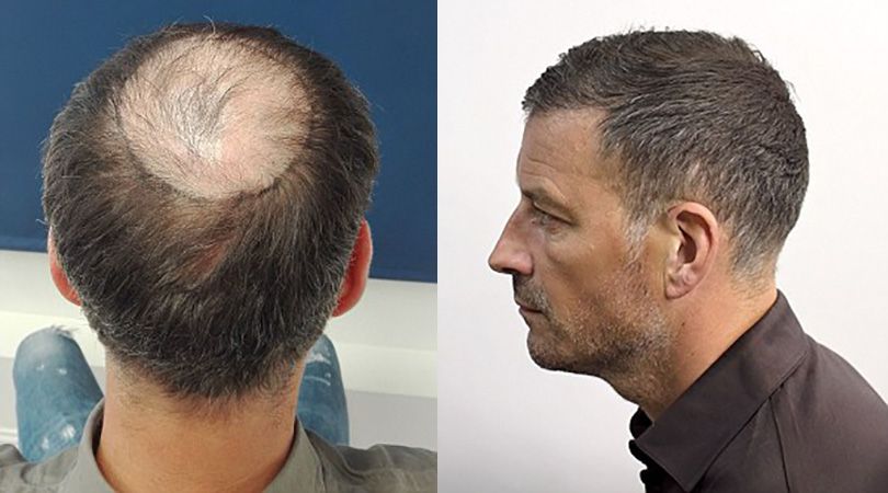 Mark Clattenburg has hair transplant to cover 'embarrassing' bald spot |  FourFourTwo
